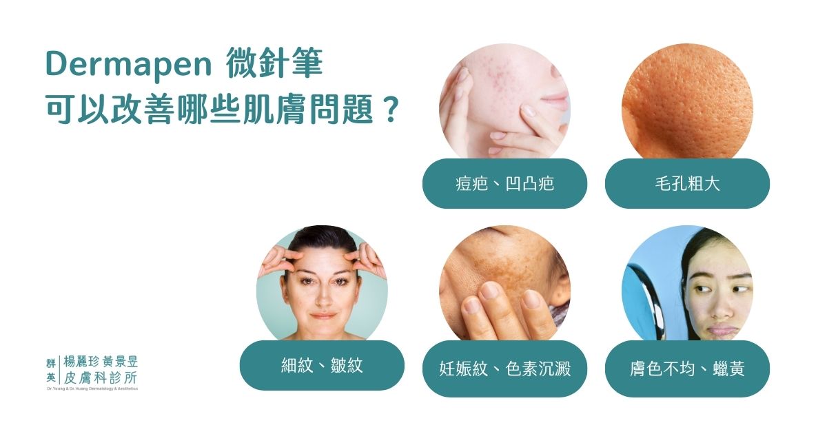 Dermapen 微針筆功效