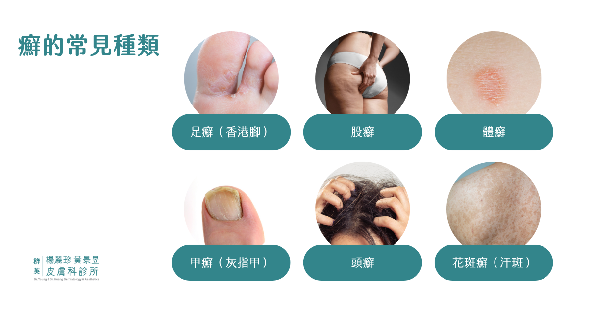 癬的常見種類