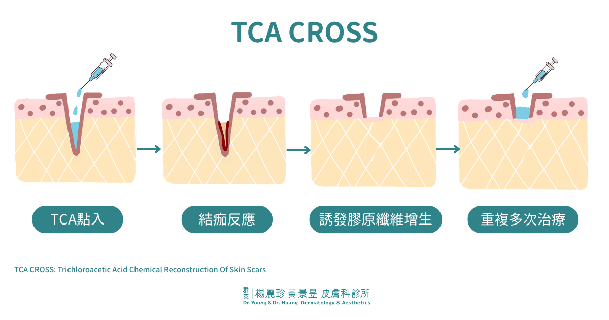 TCA CROSS療法