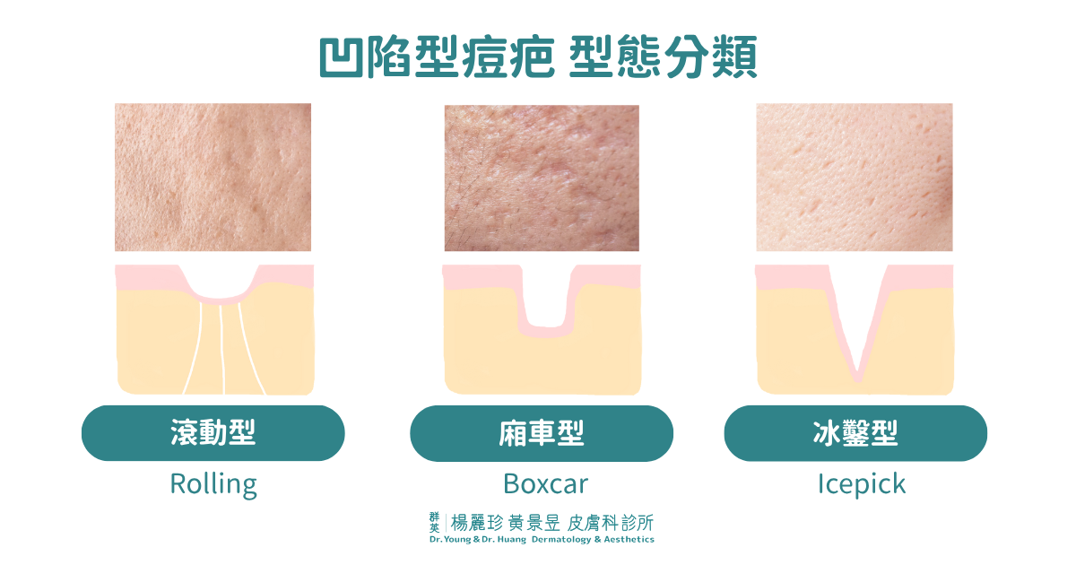 凹陷型痘疤型態
