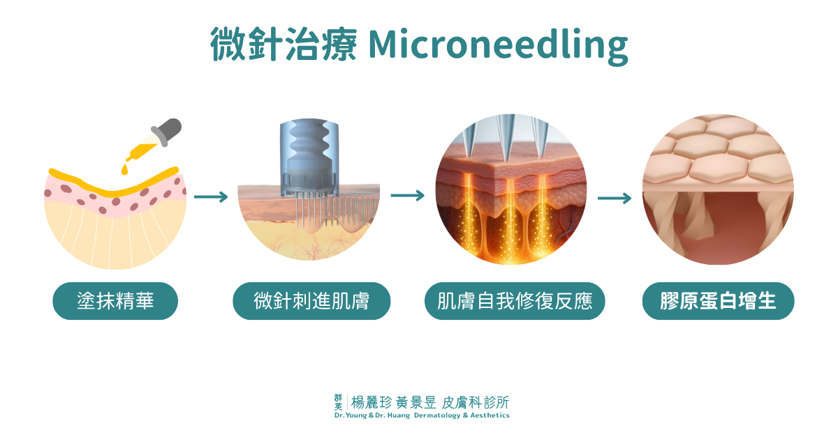 微針治療Microneedling
