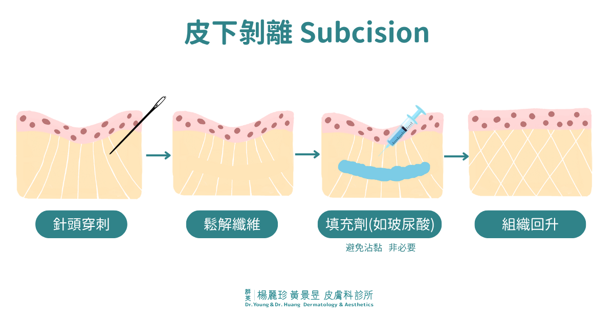 皮下剝離Subcision