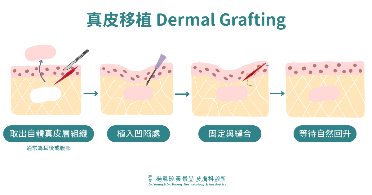 真皮移植 Dermal Grafting