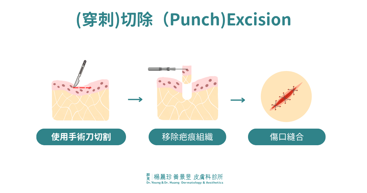 穿刺切除 Punch Excision