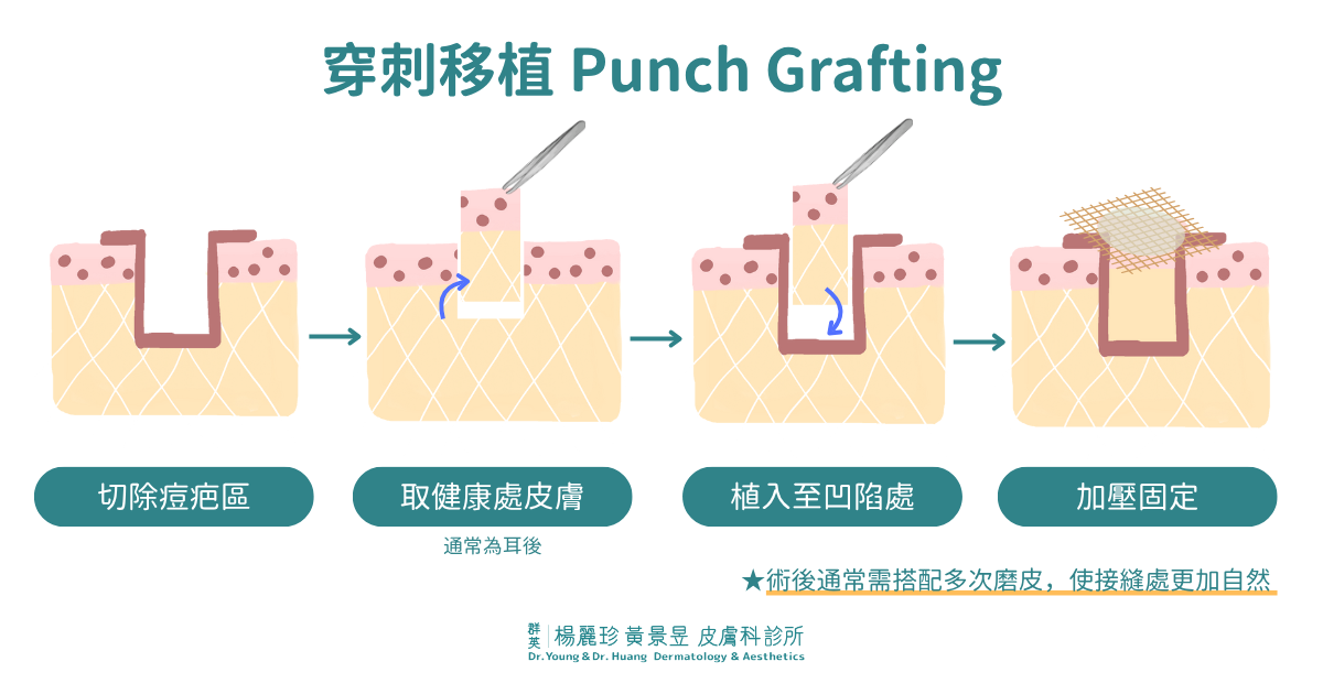 穿刺移植 Punch Grafting