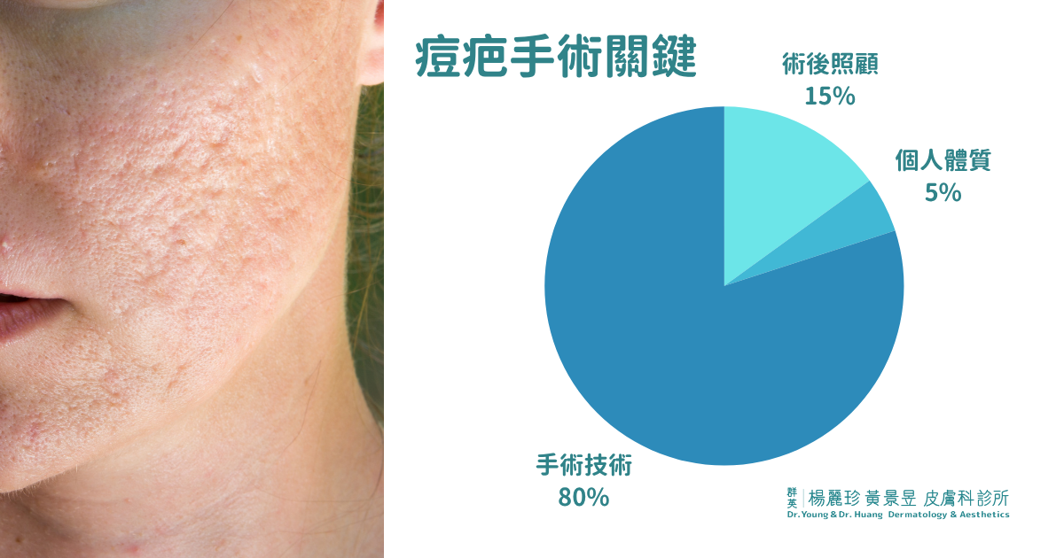 痘疤手術效果關鍵