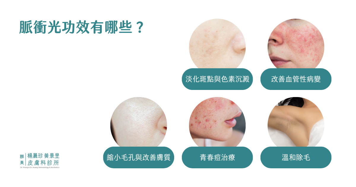 脈衝光功效有哪些？