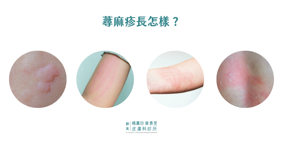 蕁麻疹長怎樣