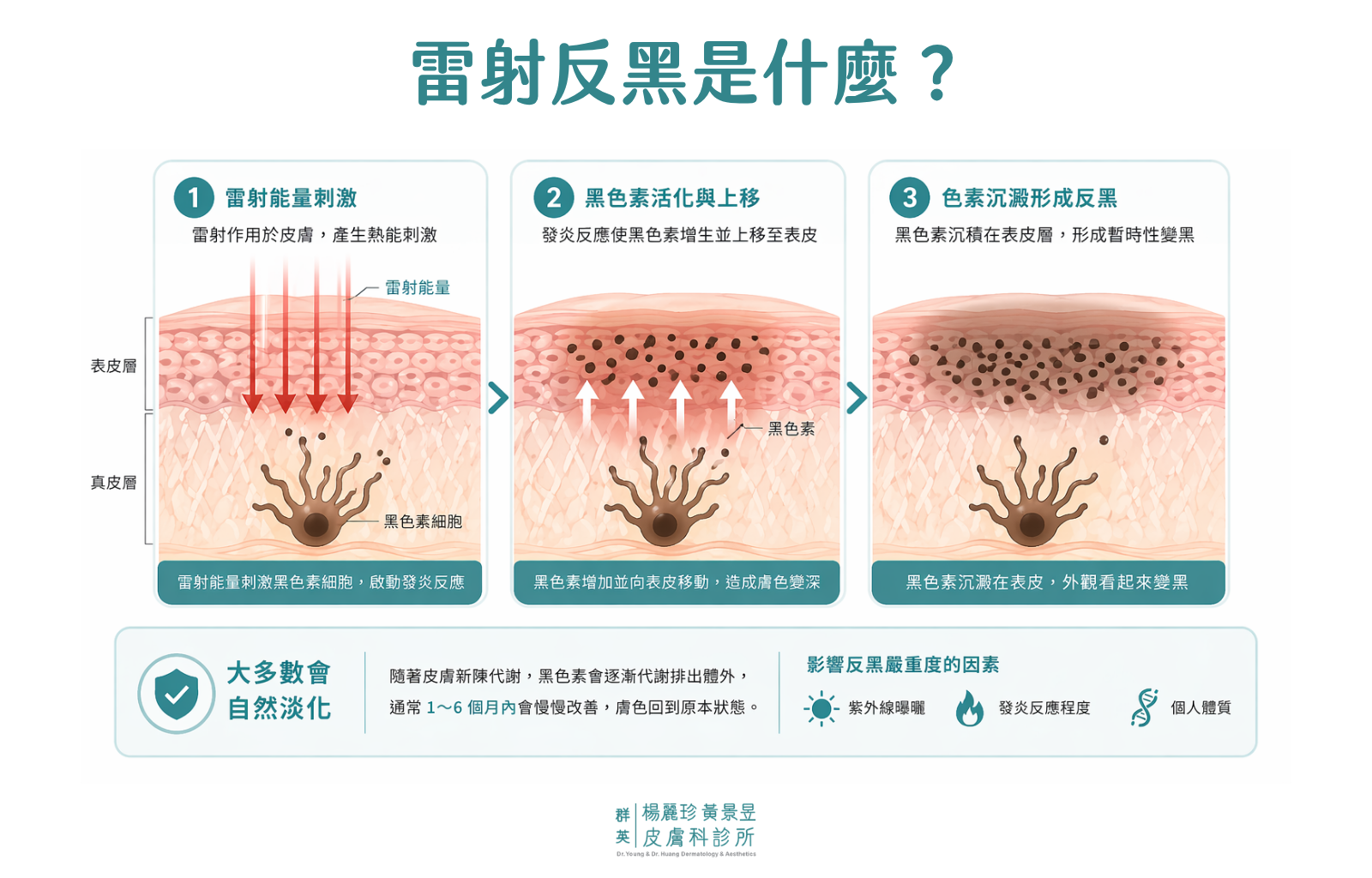 雷射反黑是什麼
