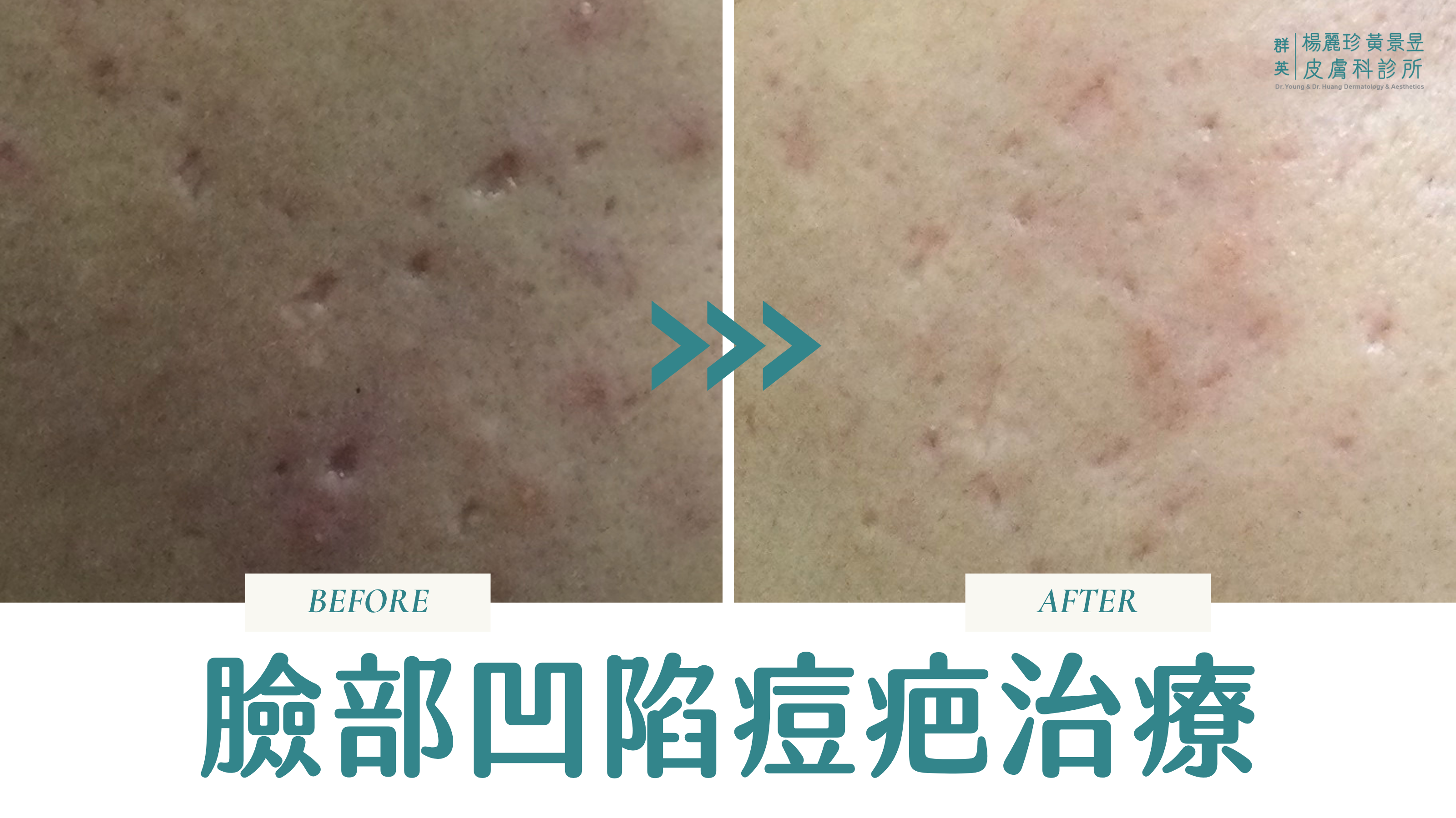 凹疤治療前後照