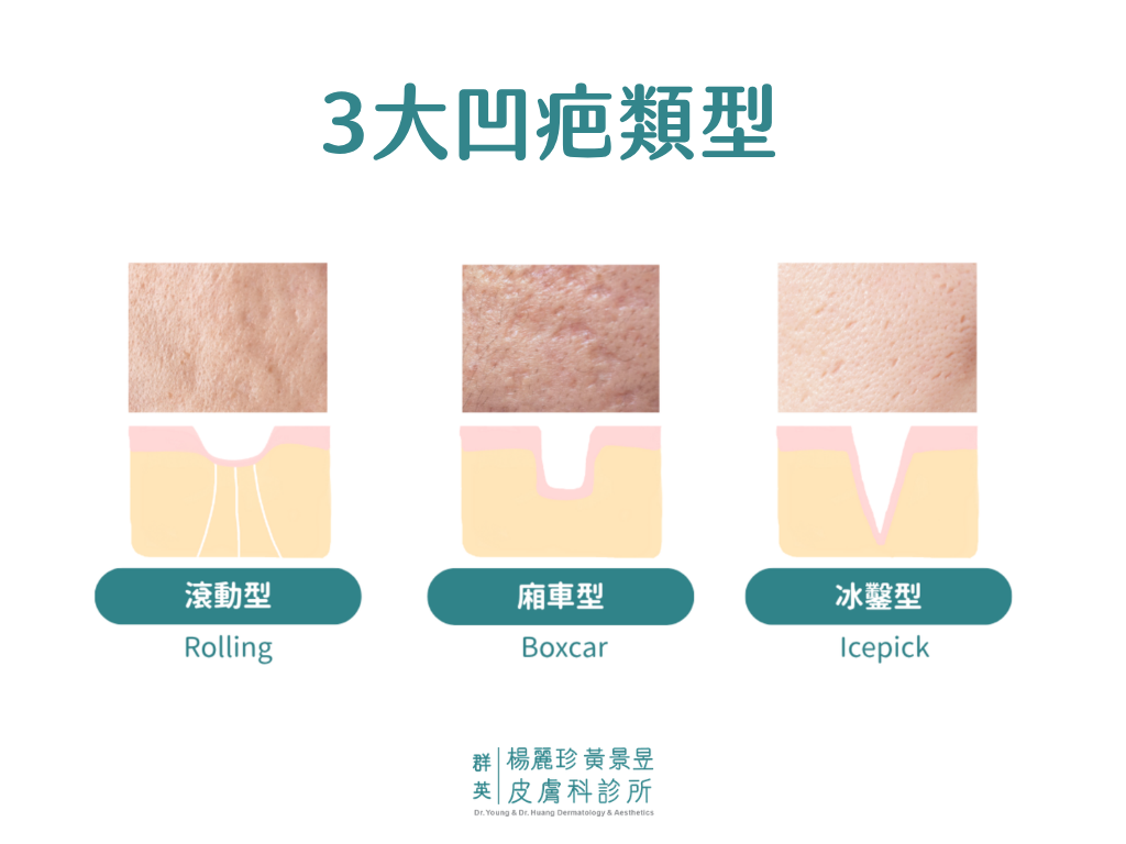 凹疤長怎樣
