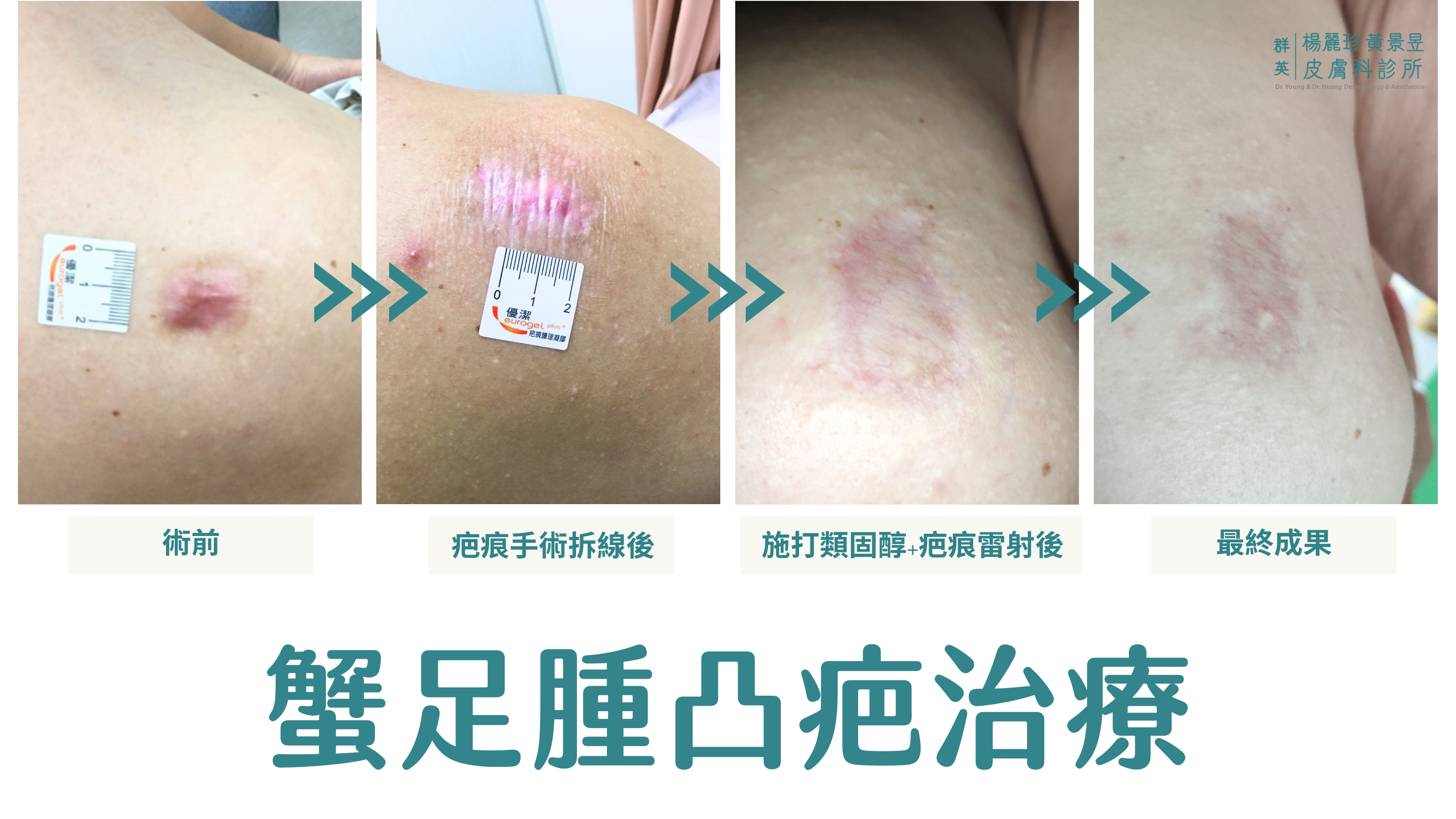 蟹足腫凸疤治療過程