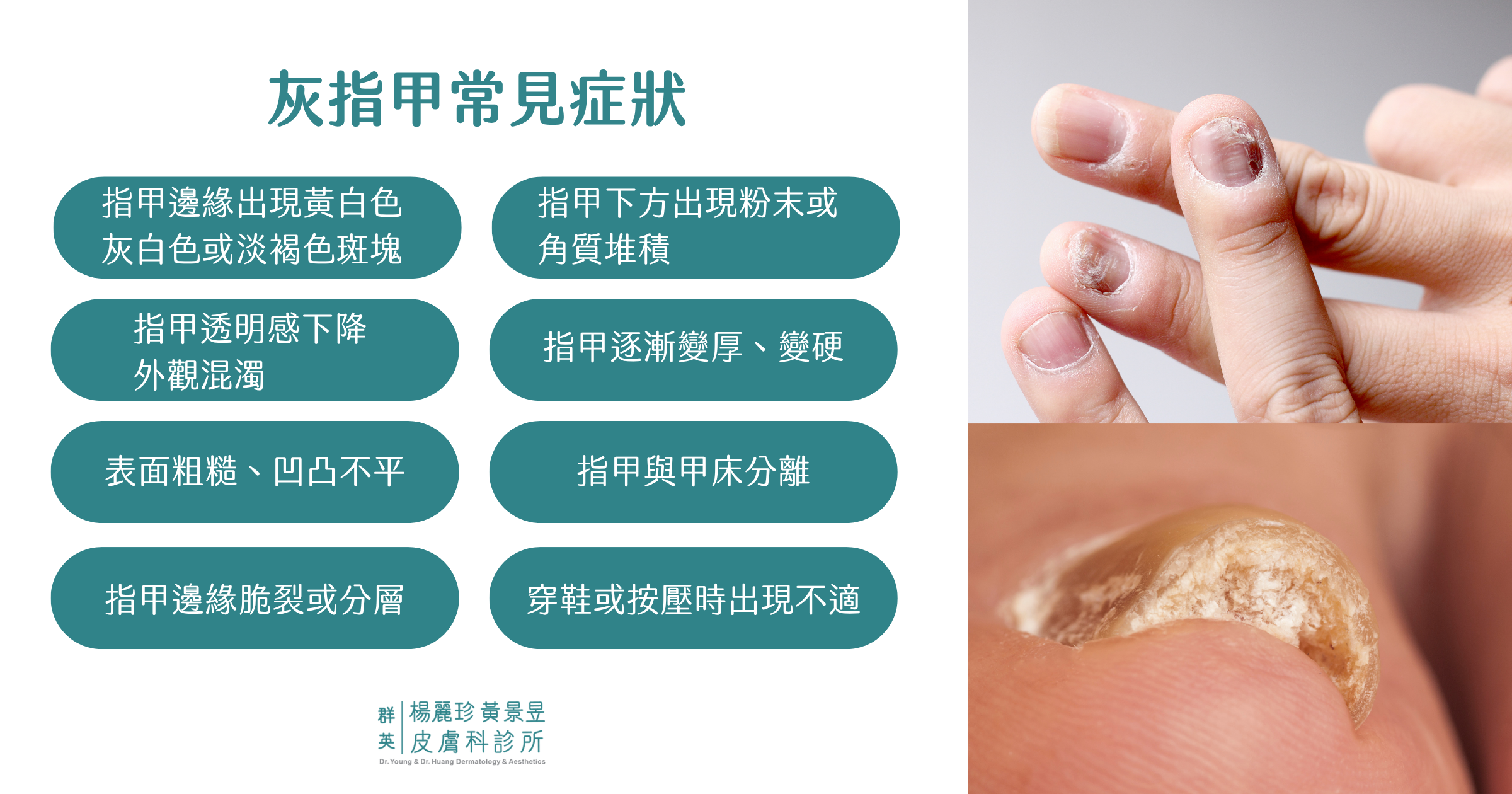 灰指甲常見症狀總覽圖
