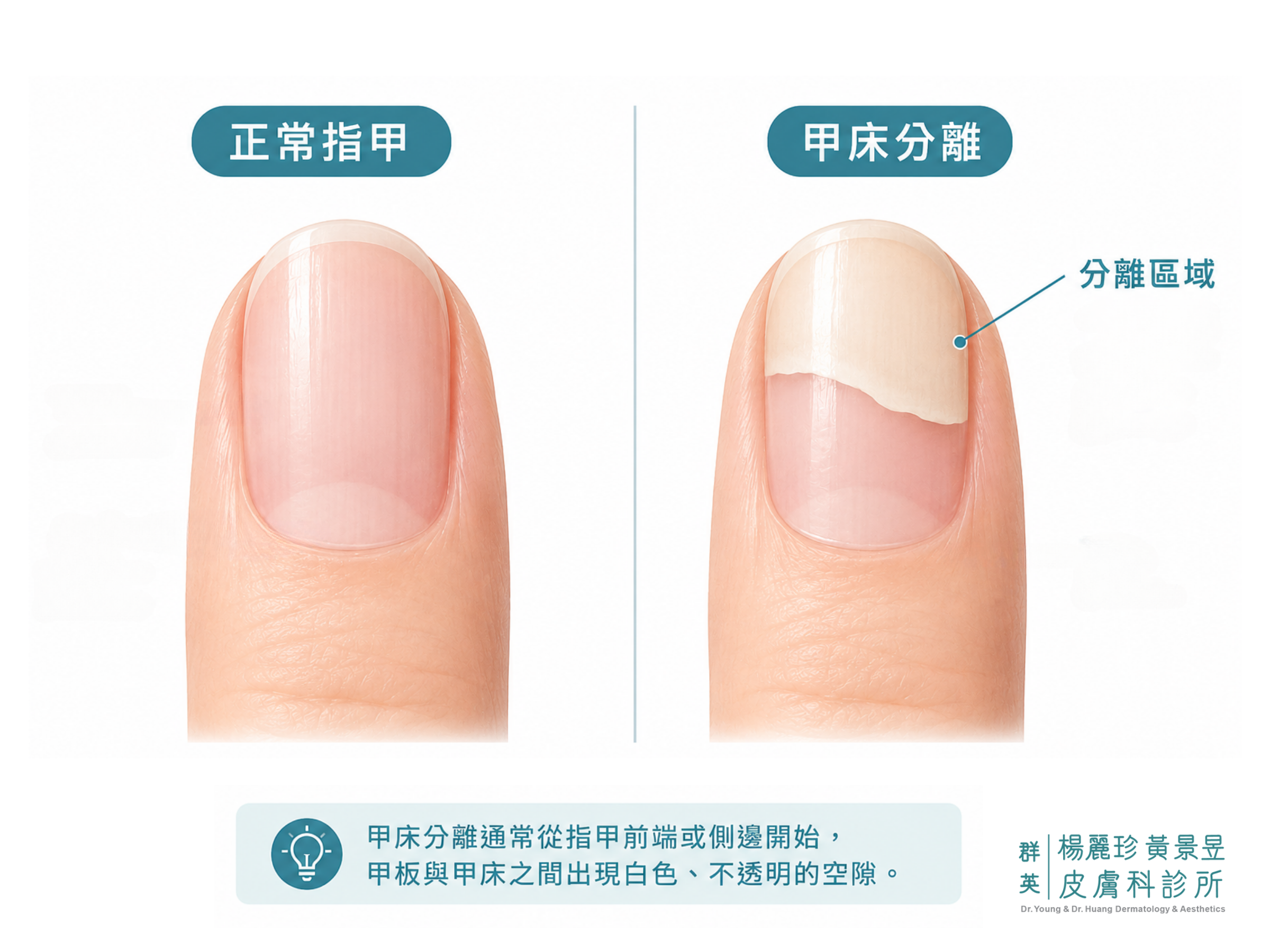 甲床分離示意圖