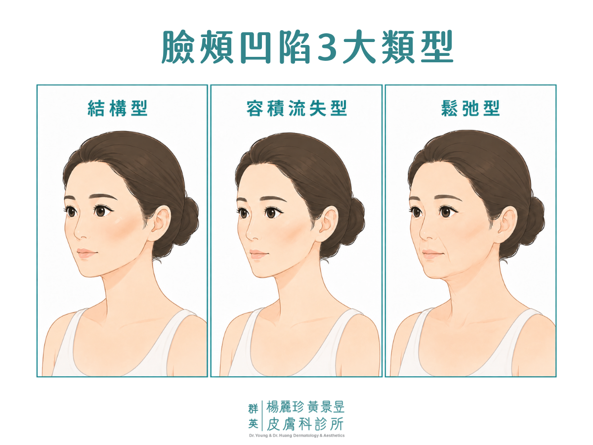 臉頰凹陷3大類型示意圖