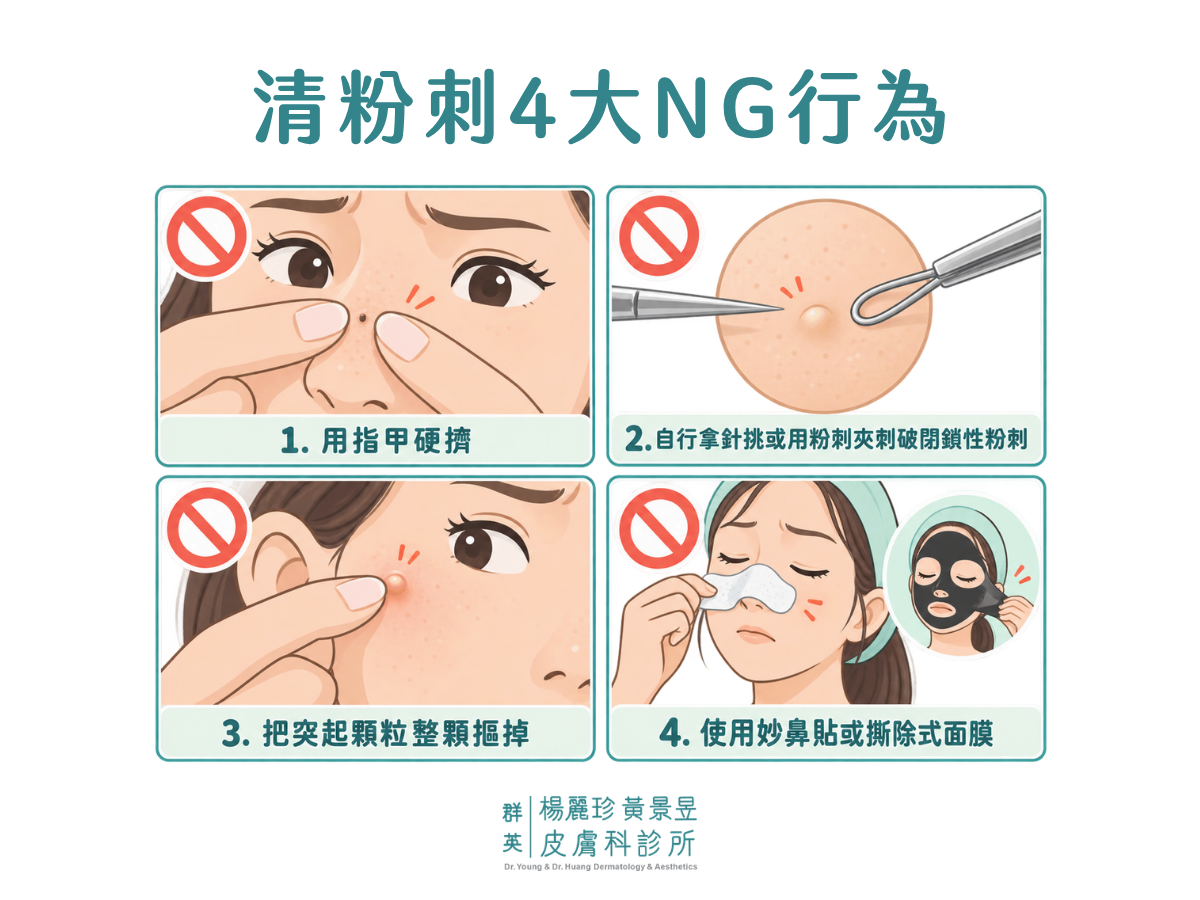 清粉刺應避免的 4 種行為：用指甲硬擠、用針或粉刺夾刺破閉鎖性粉刺、摳掉突起顆粒，以及使用鼻貼或撕除式面膜。