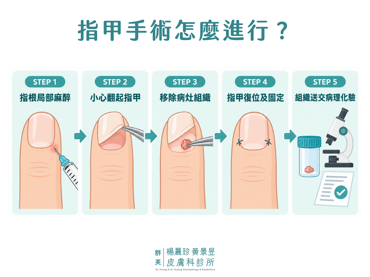 指甲乳突瘤手術流程圖，依序呈現指根局部麻醉、翻起指甲、移除病灶、指甲復位固定及組織送病理化驗 5 個步驟