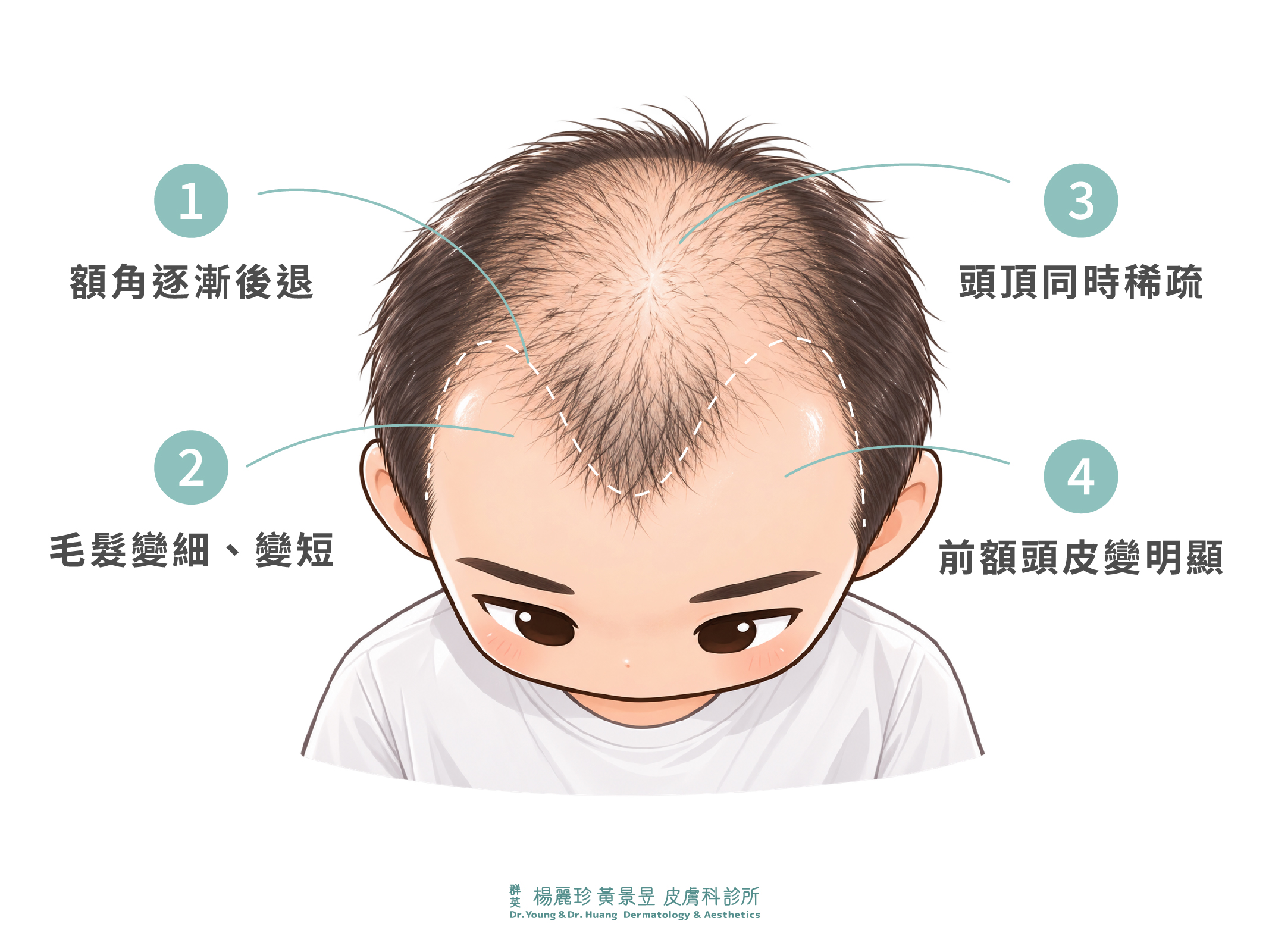 一個男人髮線後退，頭皮稀疏，呈現 Ｍ 型禿