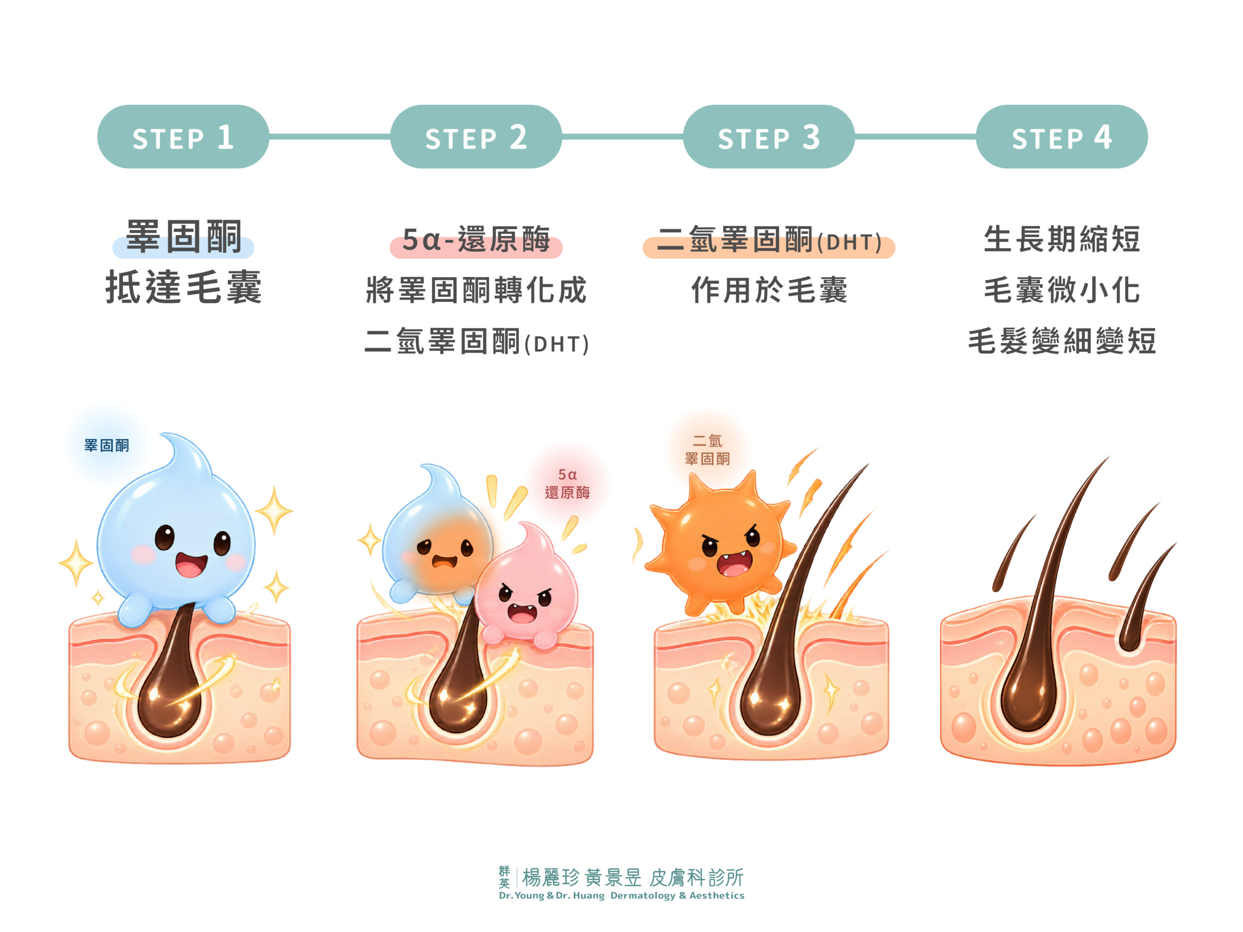 DHT形成和作用於毛囊導致落髮的過程