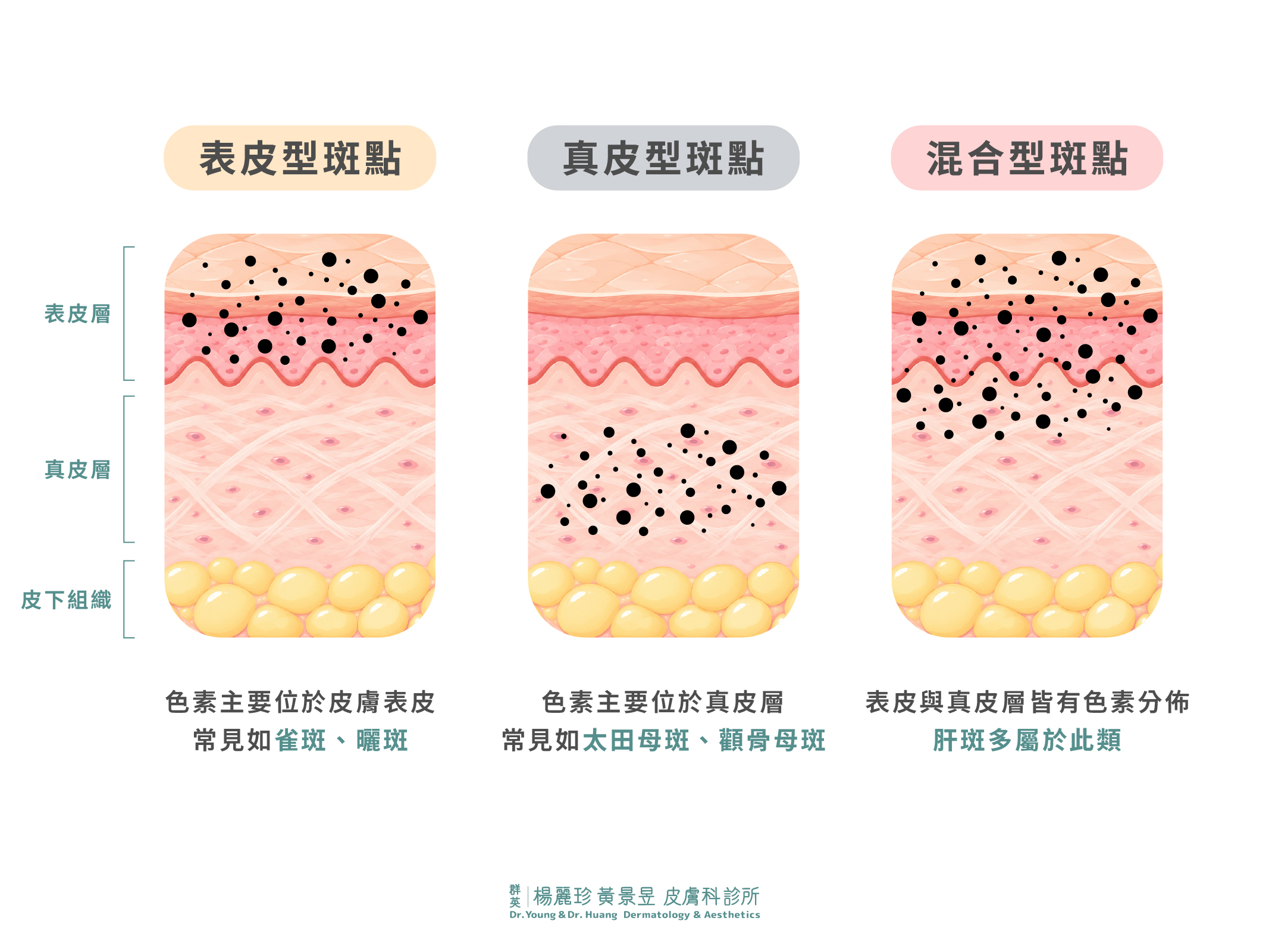 斑點依黑色素分布分成表皮型斑點、真皮型斑點和混合型斑點。