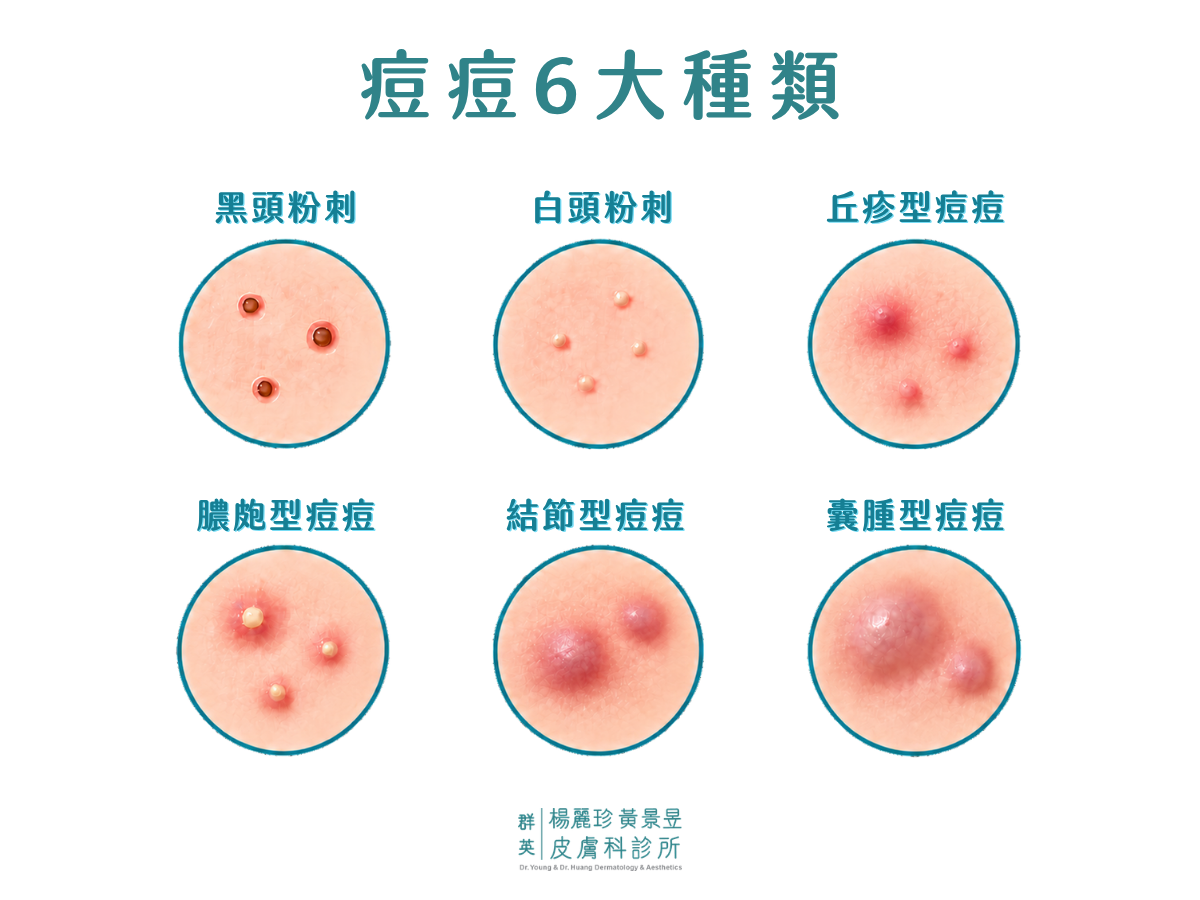 圖解常見痘痘種類外觀