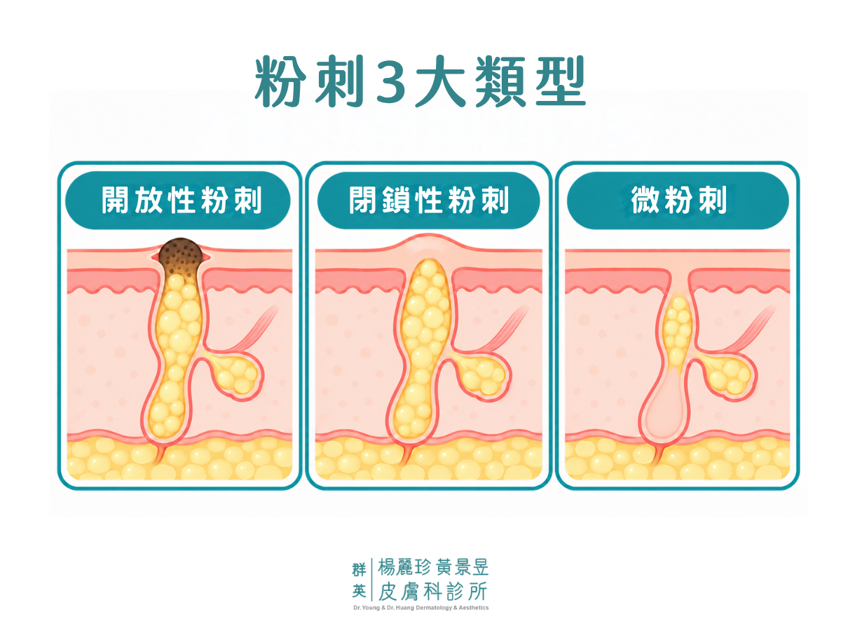3 種常見粉刺形成方式圖解，包含開放性粉刺、閉鎖性粉刺與微粉刺的毛囊阻塞差異