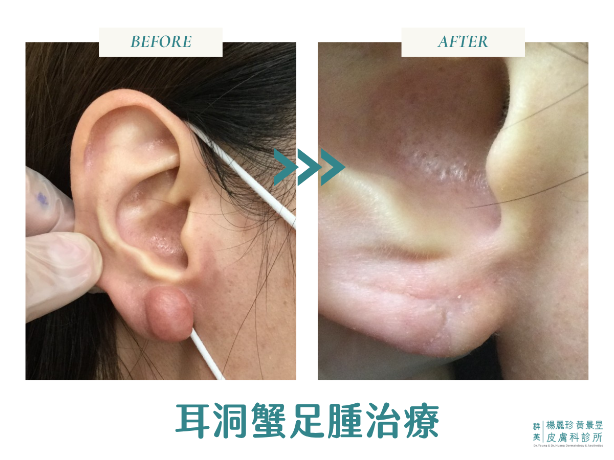 0 歲女性耳垂蟹足腫接受手術及輔助治療前後的外觀改善案例