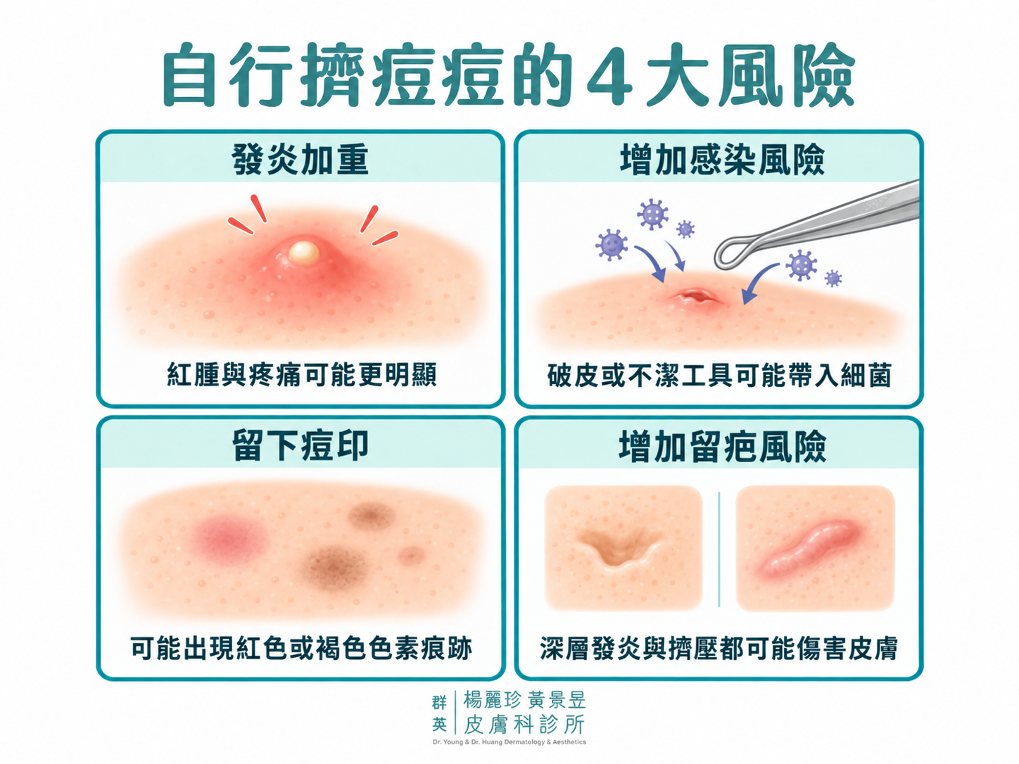 自行擠痘痘可能造成發炎加重、增加感染風險、留下紅色或褐色色素痘印，並提高凹陷或凸起疤痕的風險。