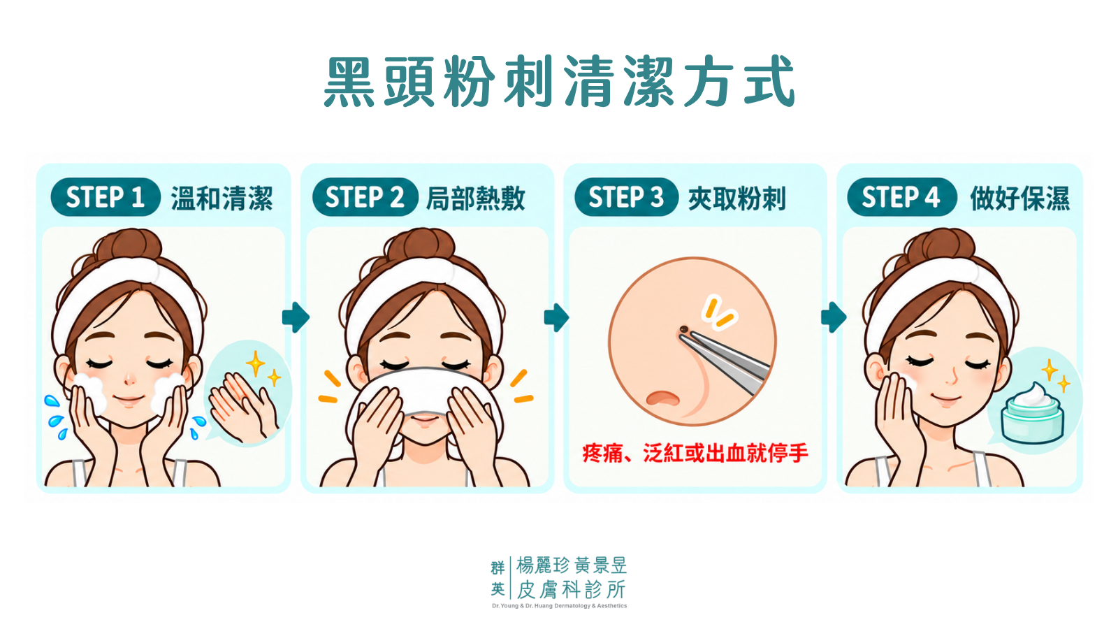 黑頭粉刺清除 4 步驟：溫和清潔、局部熱敷、輕夾已露出的粉刺，最後做好保濕。